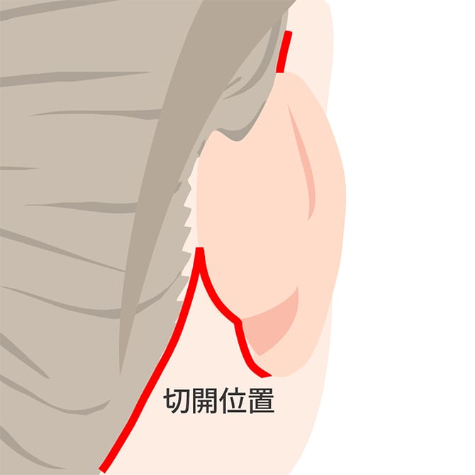 フェイスネックリフトの施術