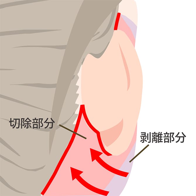 フェイスネックリフトの施術