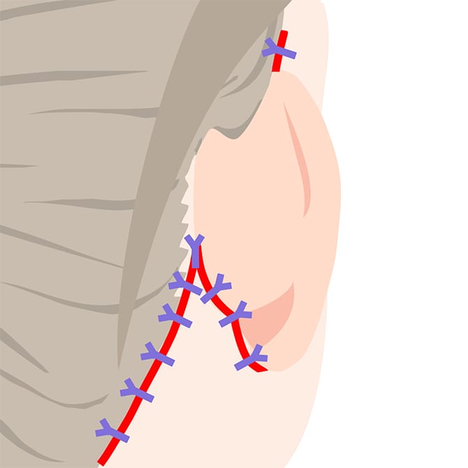 フェイスネックリフトの施術