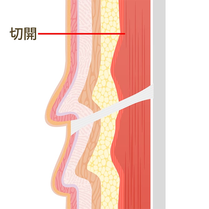 切開部分