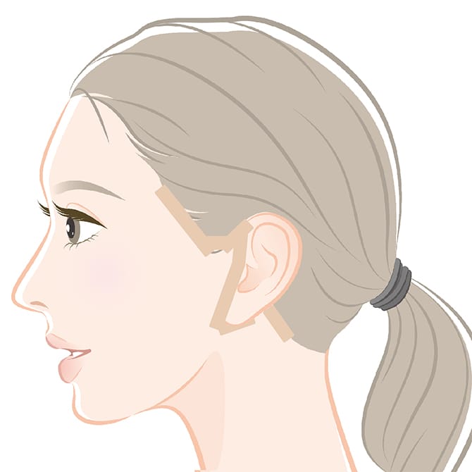 施術後にテーピングのみになった図