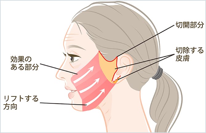 フェイスリフト