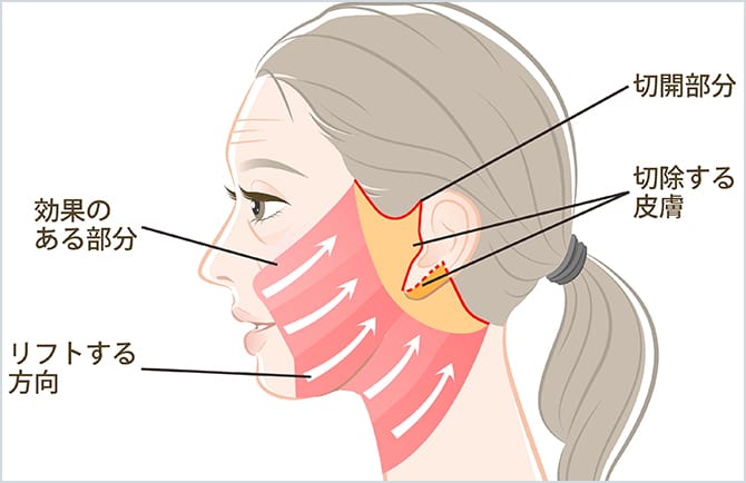 フェイスネックリフト