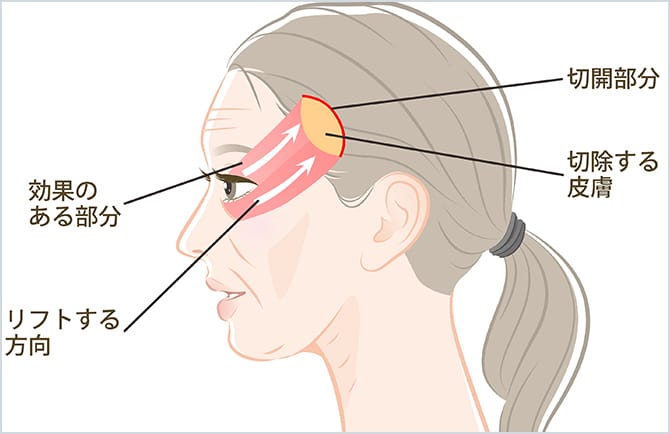 こめかみリフト