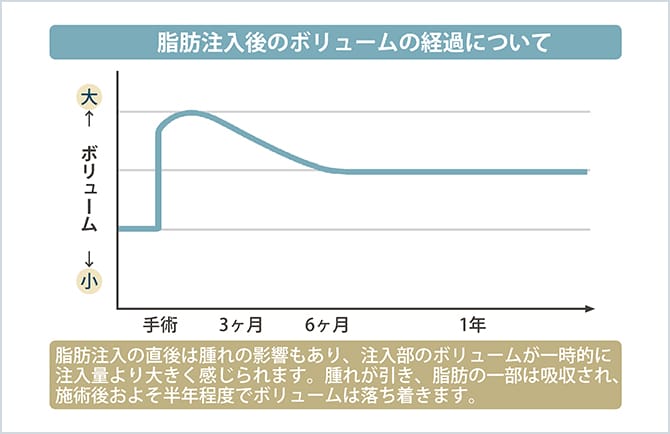 顔の脂肪注入後のボリュームの経過について