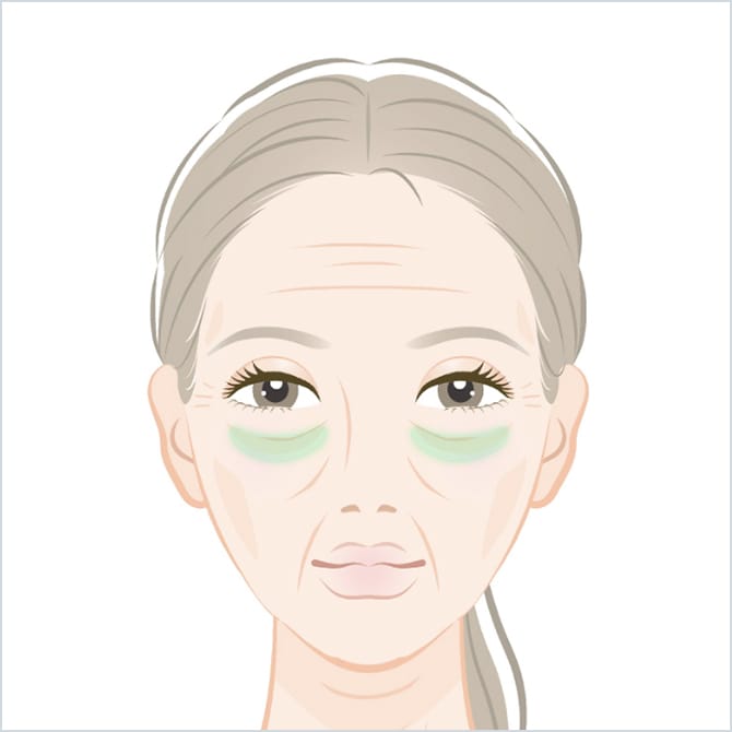 FGF注射の適応部位 目の下の図