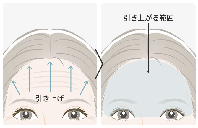 額を引き上げて目から上を若々しく
