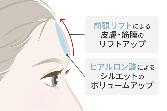 額のシワをより改善