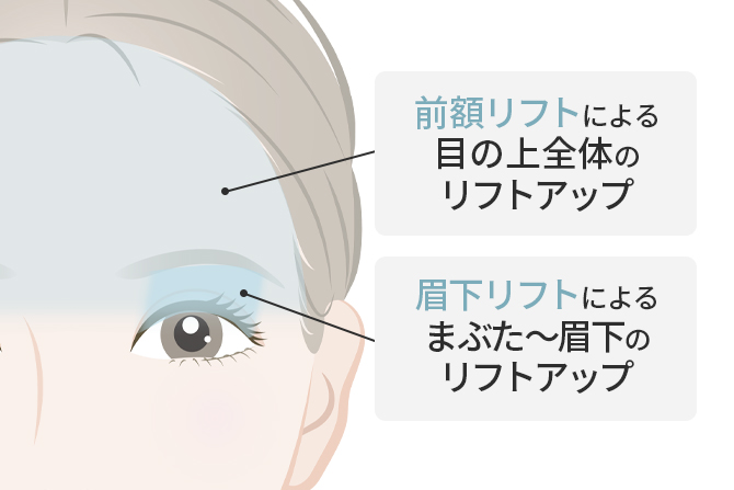 目の開きをより良く