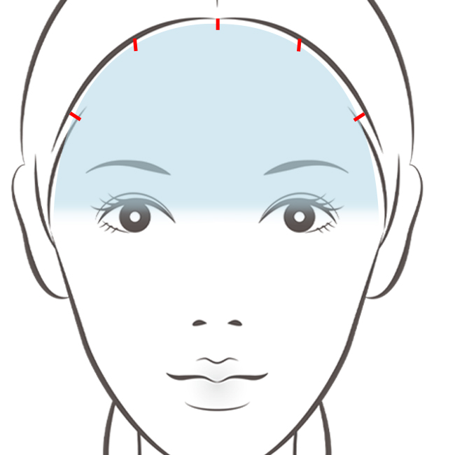 額リフト（内視鏡法）