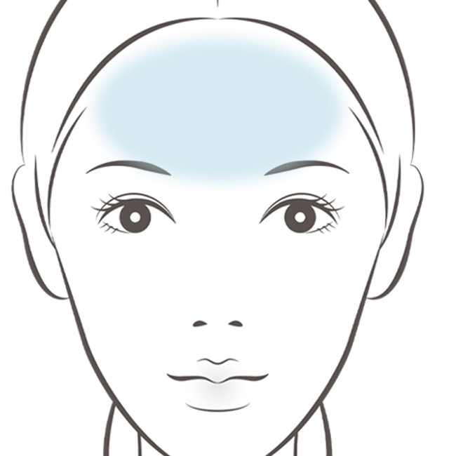 ヒアルロン酸注入リフト