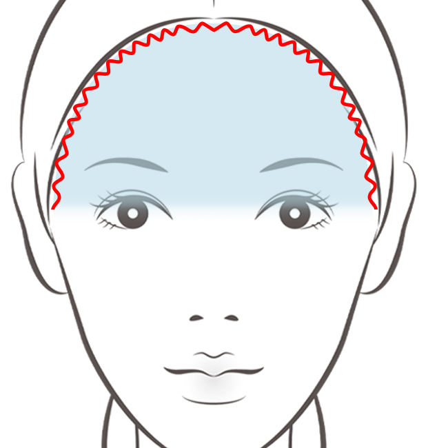 額リフト切開法<（額縮小術）