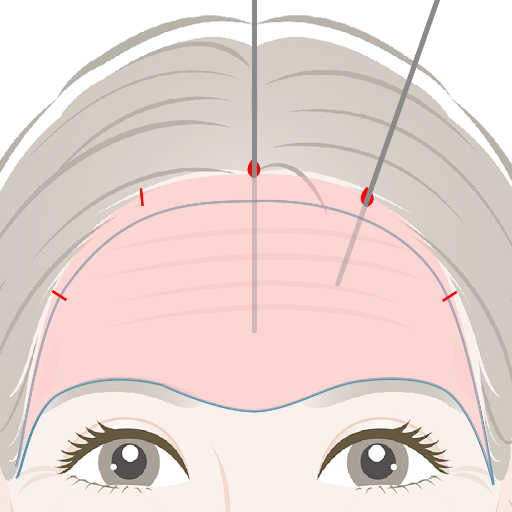 眉の位置や額のシワの状態を確認