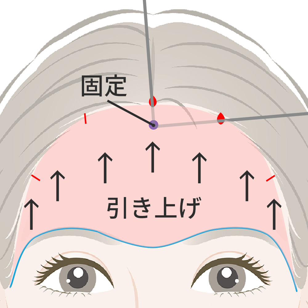 筋膜を引き上げ、内部でしっかりと固定