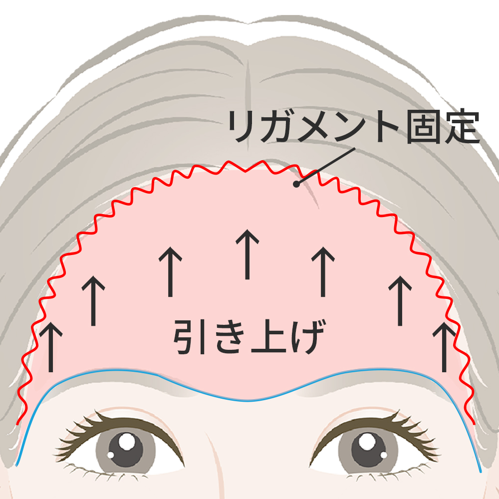 筋膜を引き上げ、内部でしっかりと固定