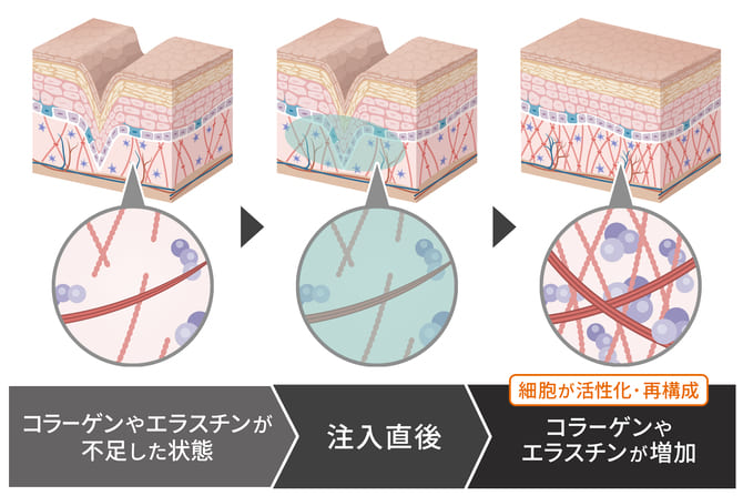 コラーゲンを増産させる新たな美肌注射