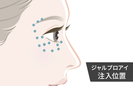 ジャルプロ アイの注入位置