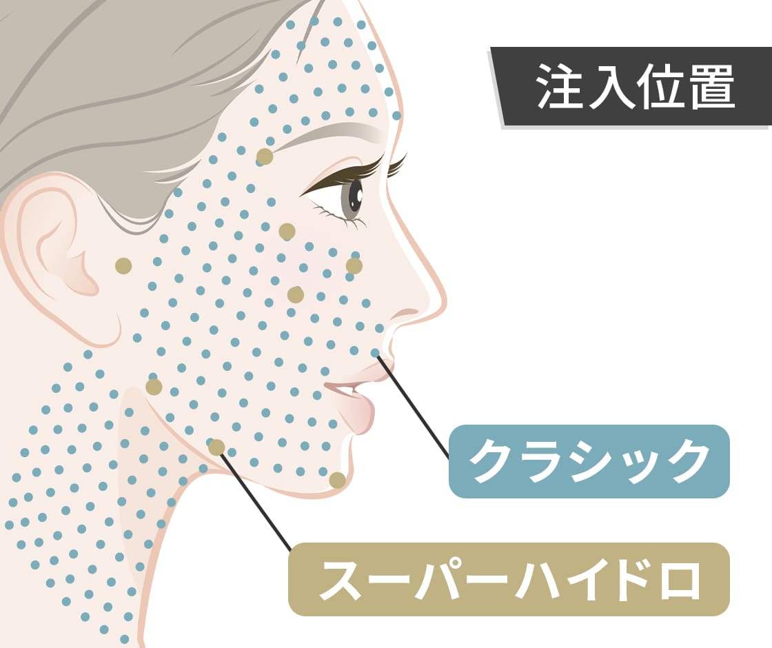 複数の製剤を組み合わせたコンビネーション注入