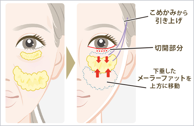 ミッドフェイスリフト