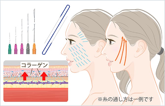 糸リフトのイラスト