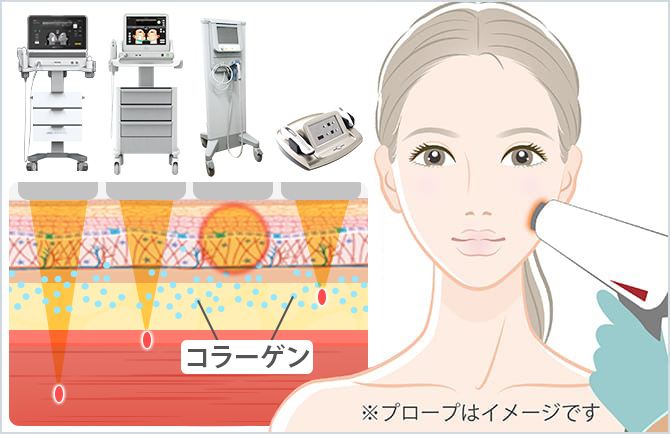 レーザーによるリフトアップ