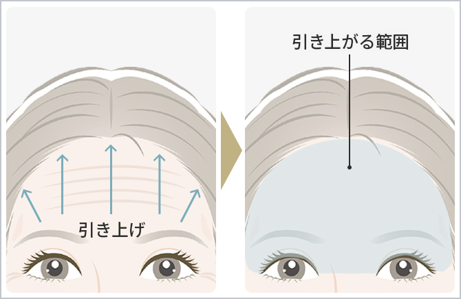 ミッドフェイスリフト