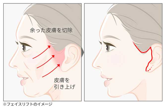 フェイスリフト