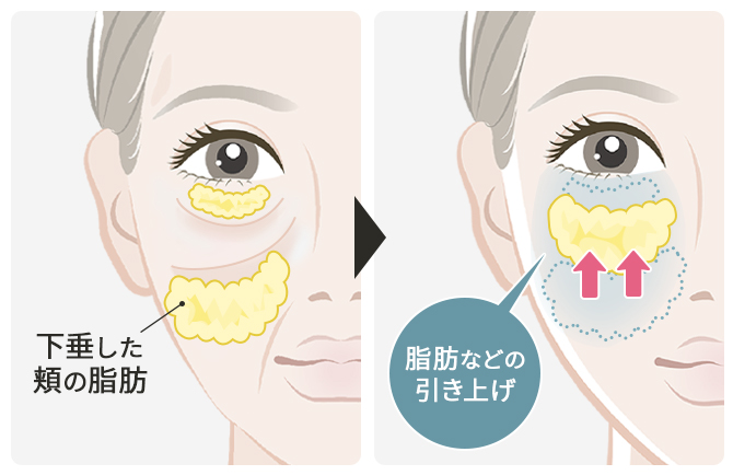頬の脂肪などを引き上げて若々しく