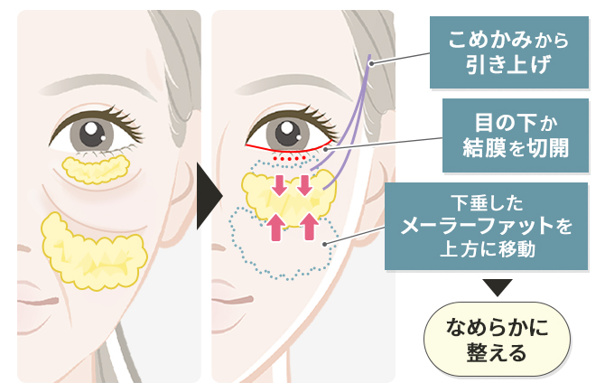 傷痕が見えづらい施術方法