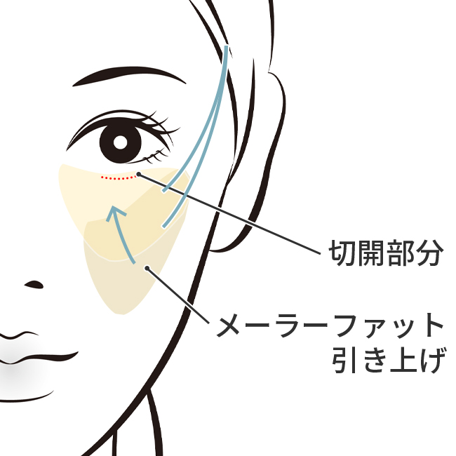 ミッドフェイスリフト結膜切開法