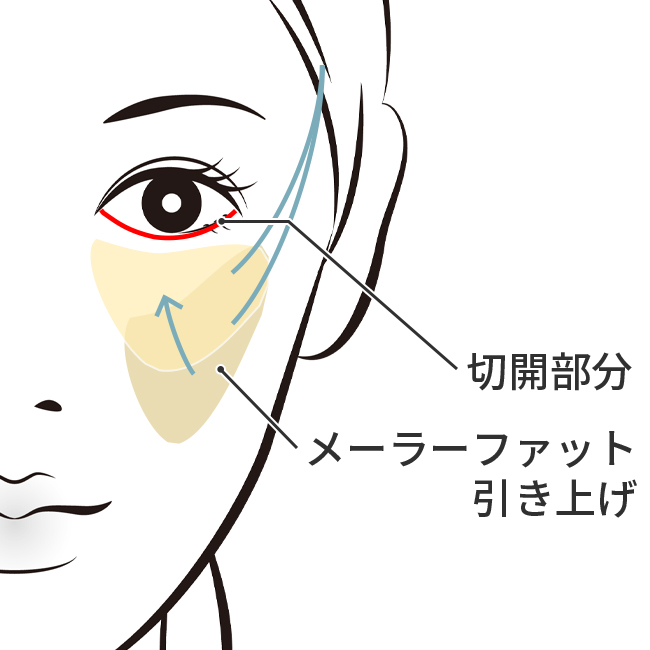 ミッドフェイスリフト目の下切開法