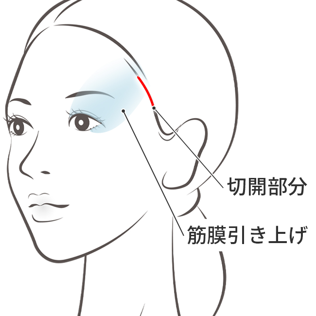 こめかみリフト