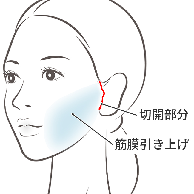 ミニフェイスリフト(MACSリフト)