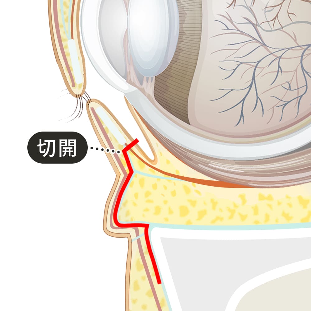 切開箇所の断面