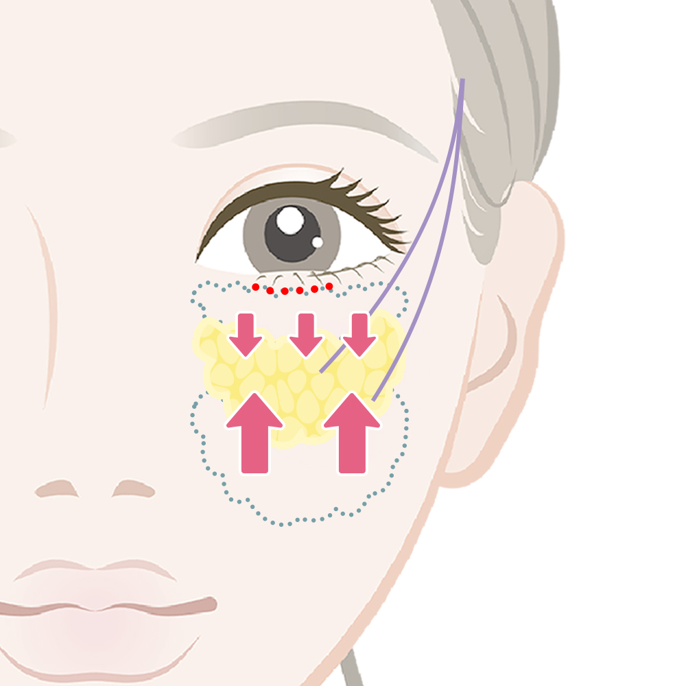 脂肪の移動・固定