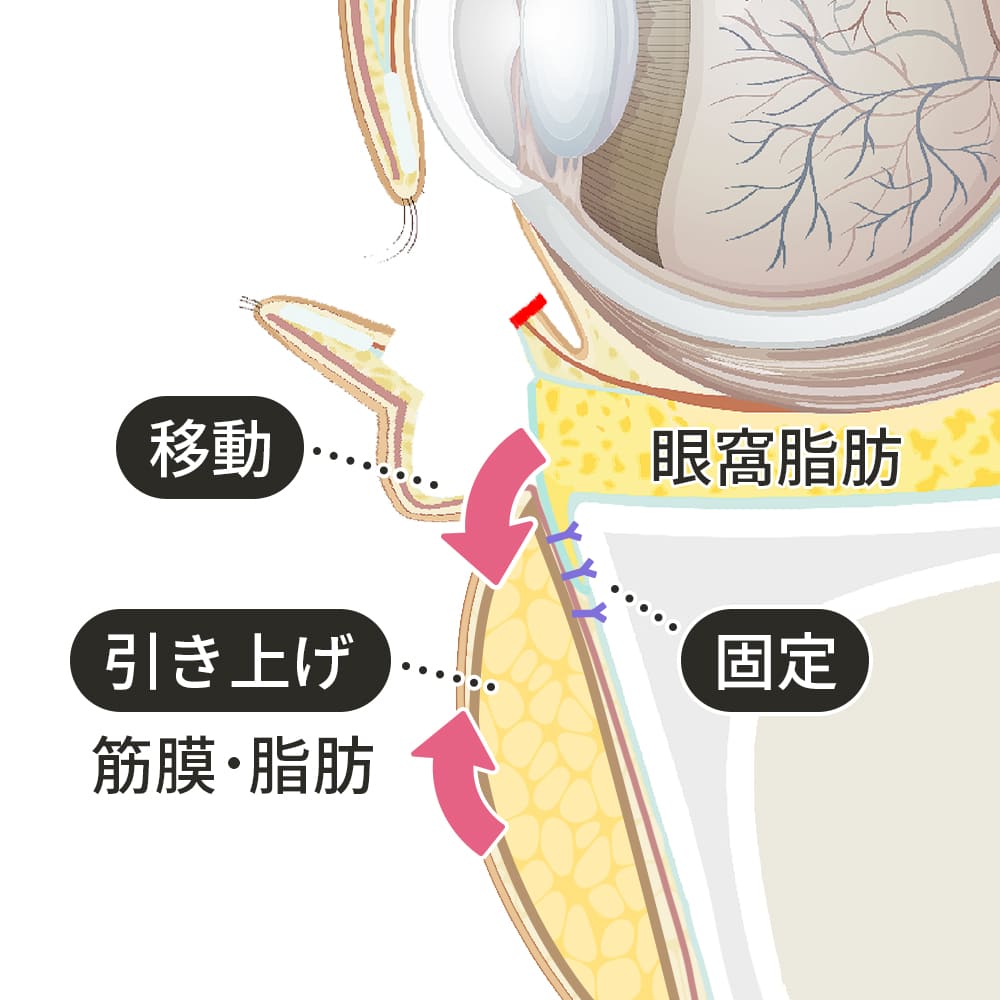 脂肪の移動・固定箇所の断面