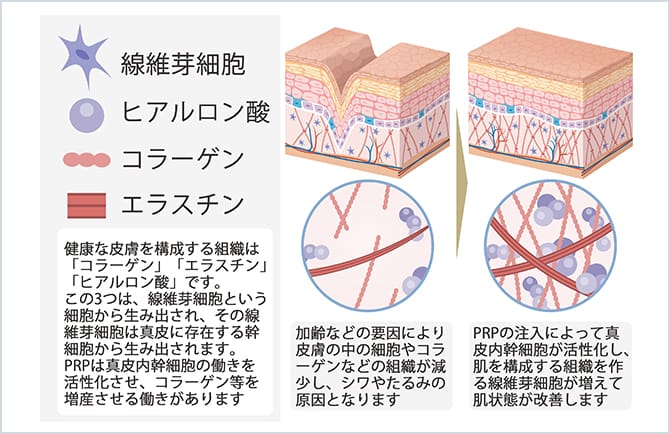 PRPの注入によって真皮内幹細胞が活性化する説明図