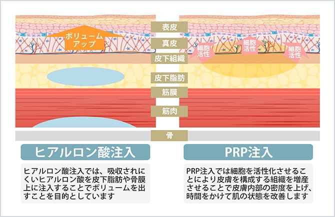 ヒアルロン酸注入とPRP注入の違いの図
