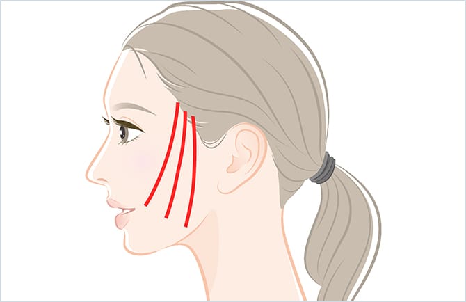 ミントリフトの使用