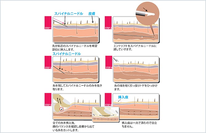 ミントリフトの施術