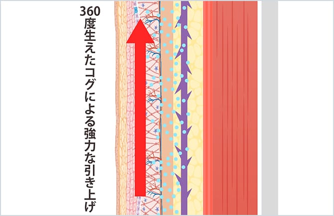 360度生えたコグによる強力な引き上げ