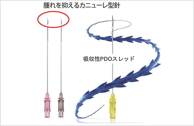 腫れを抑えるカニューレ型針と吸収性PODスレッドの写真