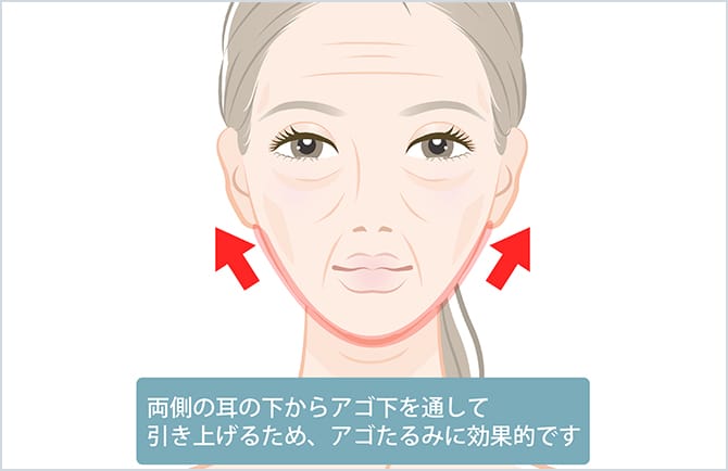 バイニードルの施術