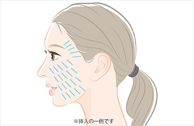 ショッピングリフトの挿入