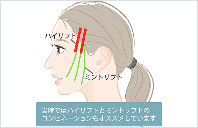 ハイリフトとミントリフトのコンビネーション
