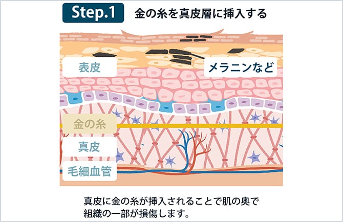 Step1 金の糸を真皮層に挿入する図