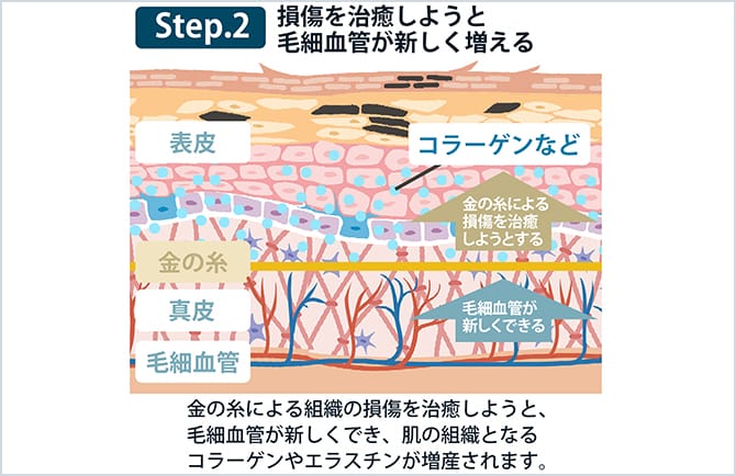 Step2 損傷を治癒しようと毛細血管が新しく増える図