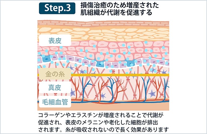 Step3 損傷治癒のため増産されたお肌組織が代謝を促進する