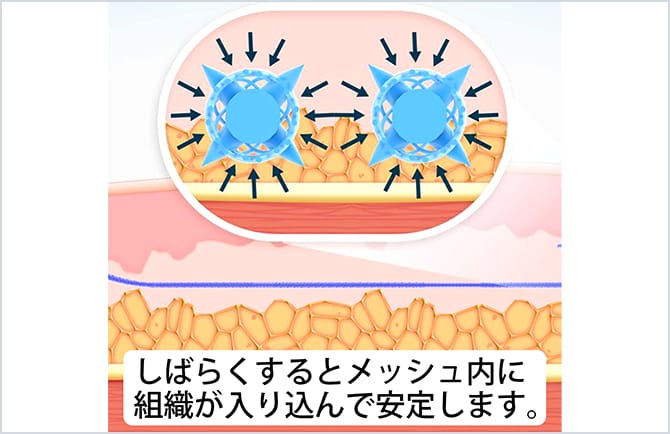 メッシュ内に組織が入り込んで安定する
