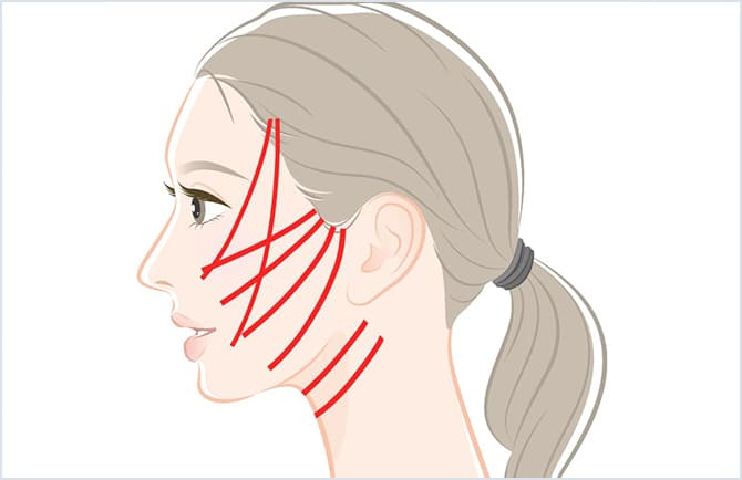 3Dスパイラルリフト使用